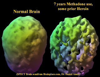 4 Things To Know About Opiate Treatment