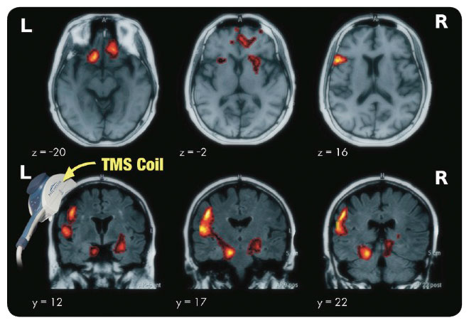 TMS Therapy and Depression Treatment